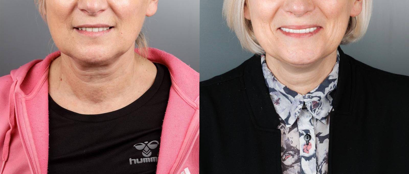Mund vor und nach der Behandlung