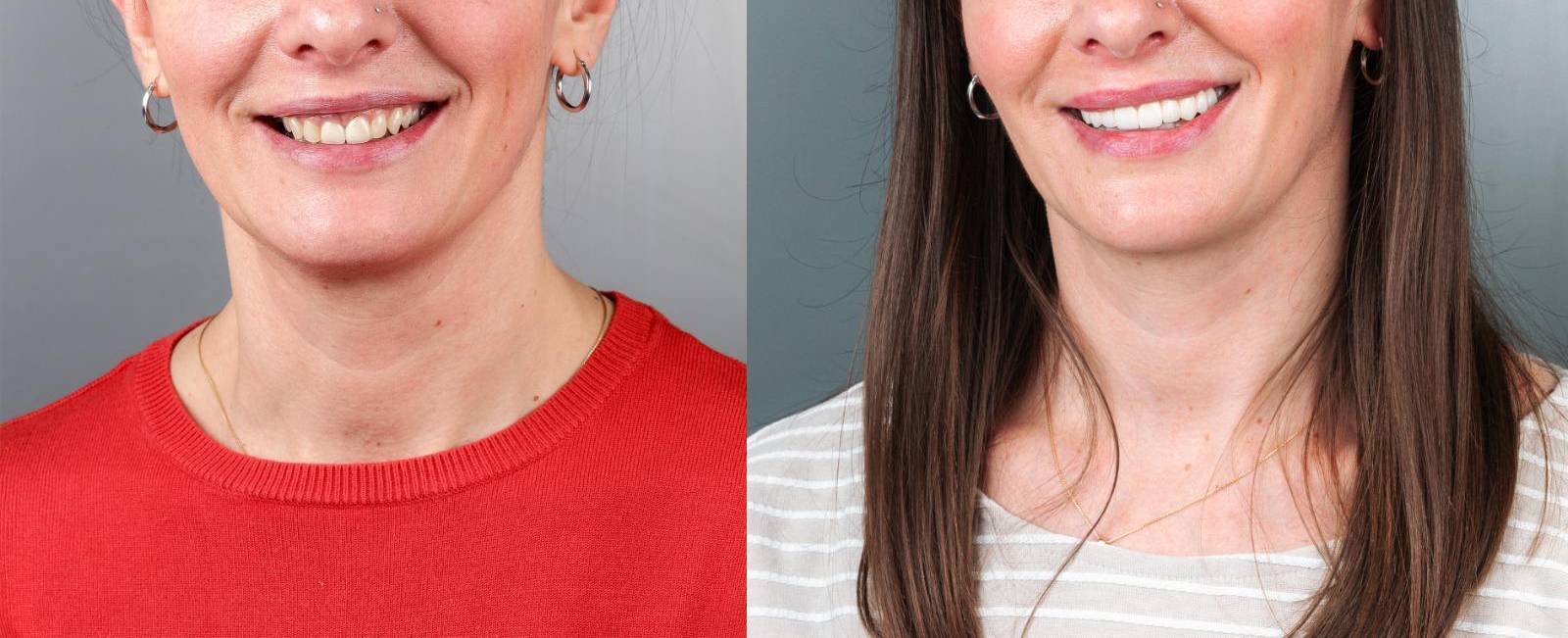 Mund vor und nach der ästhetischen Versorgung