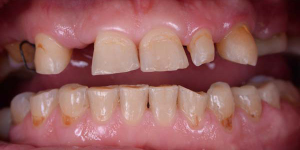 https://dentalreise.ch/wp-content/uploads/2022/09/before-after-dental-implants-smile-restoration.jpg