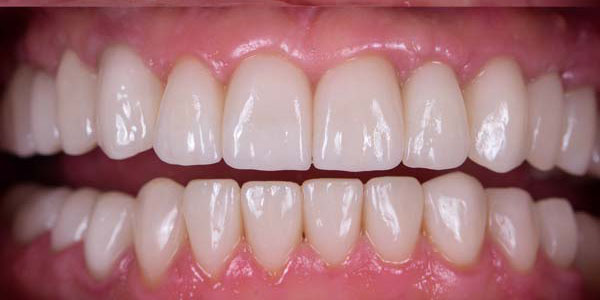 https://dentalreise.ch/wp-content/uploads/2022/09/before-after-dental-implants-smile-restorationa1.jpg